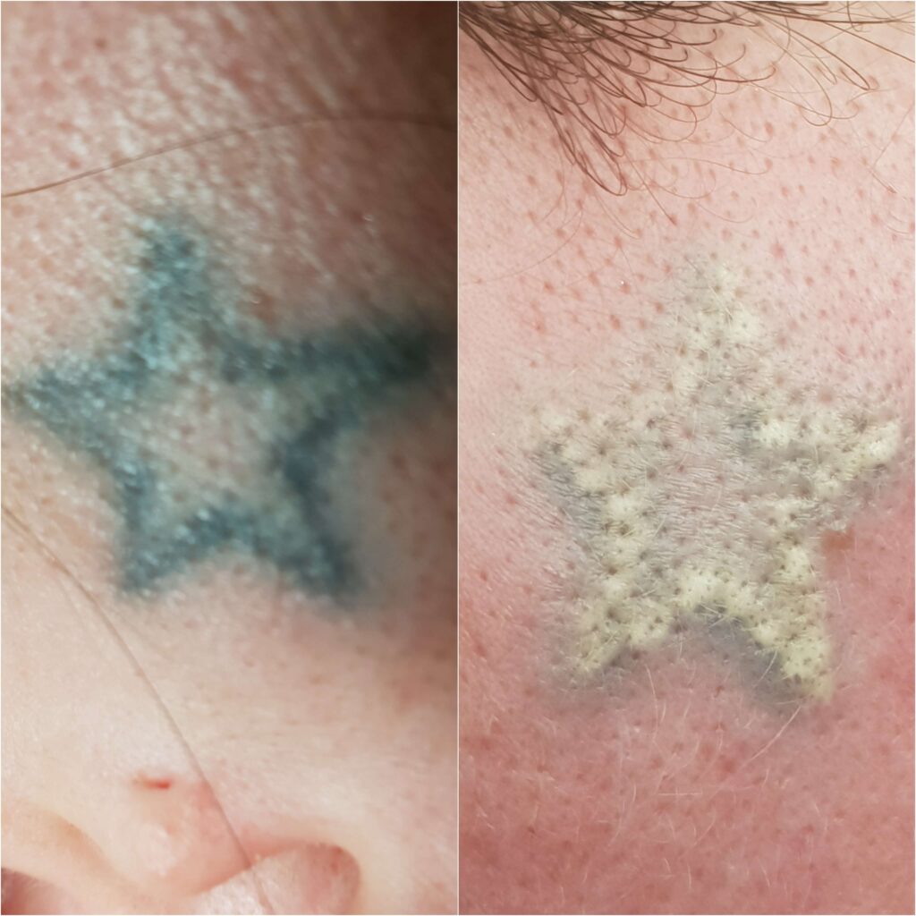 laserowe usuwanie tatuażu